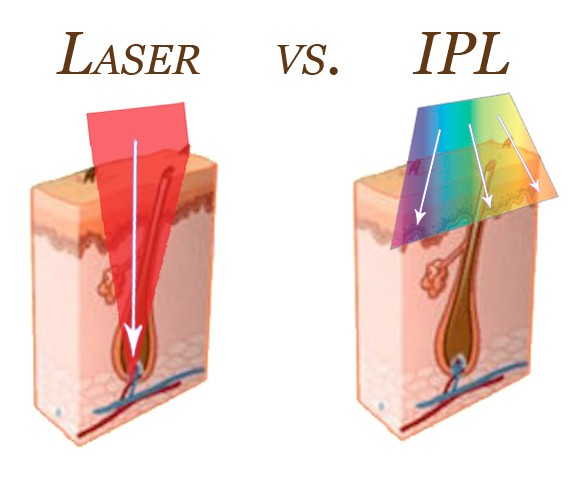 IPL กับเลเซอร์แตกต่างกันอย่างไร?