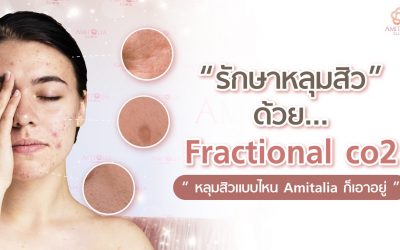 รักษาหลุมสิวด้วย Fractional co2