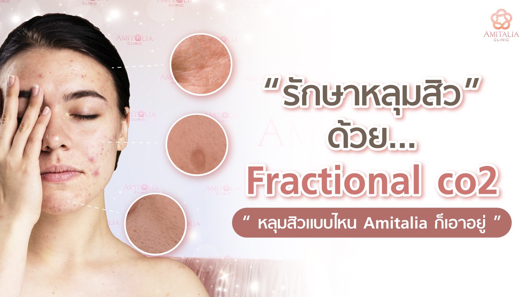 รักษาหลุมสิวด้วย Fractional co2