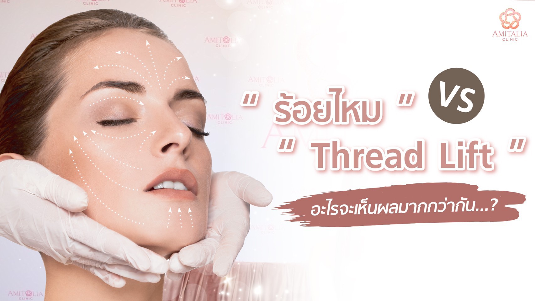 Hifu vs Thread Lift อะไรเห็นผลมากกว่ากัน?