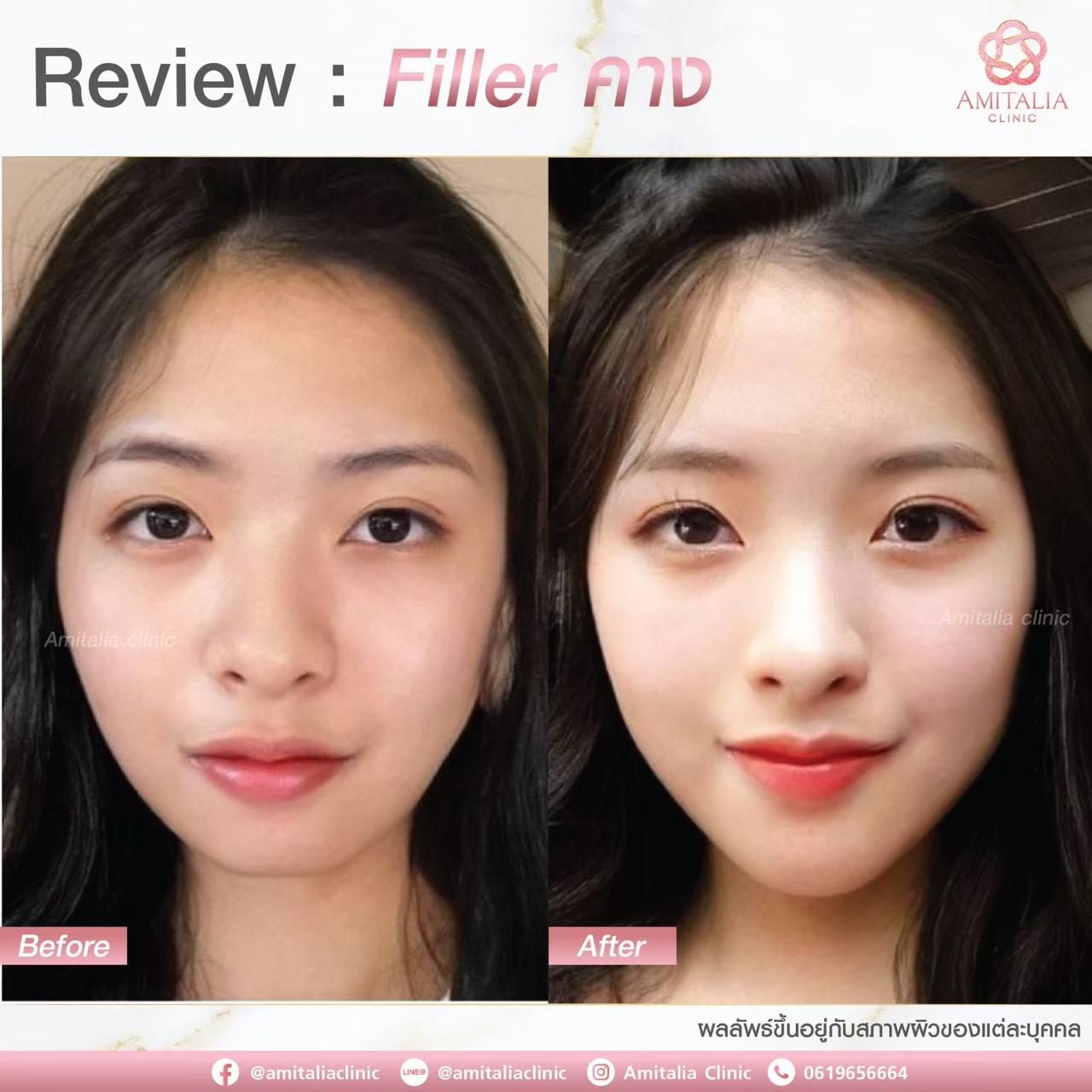 Review Filler คาง #1