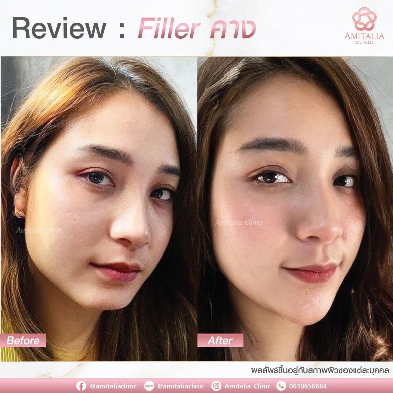 Review Filler คาง #15