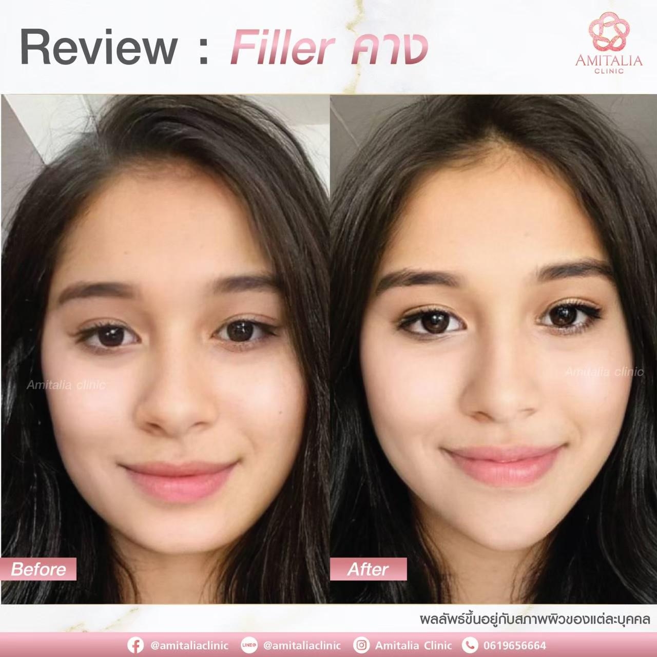 Review Filler คาง #2
