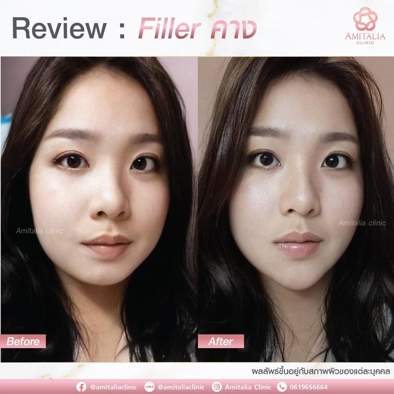 Review Filler คาง5-AmitaliaClinic