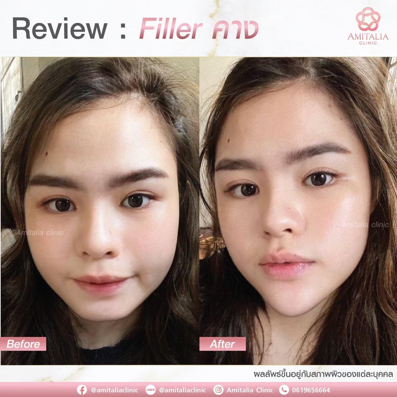 Review Filler คาง #6
