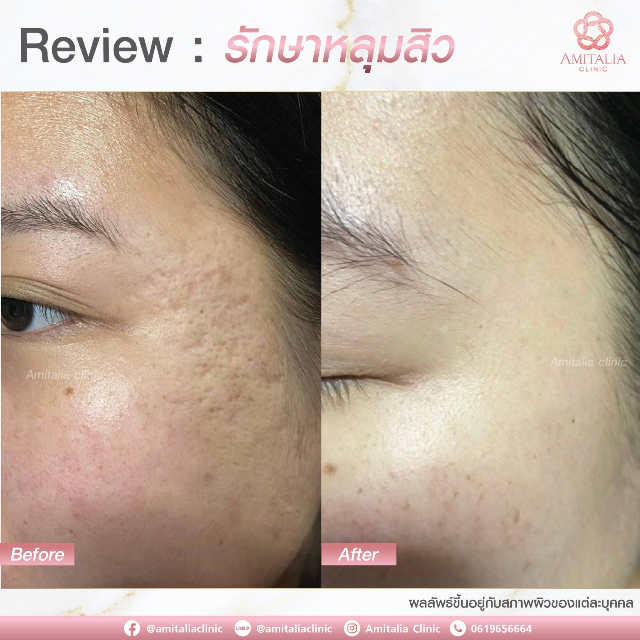 Review รักษาหลุมสิว10-AmitaliaClinic