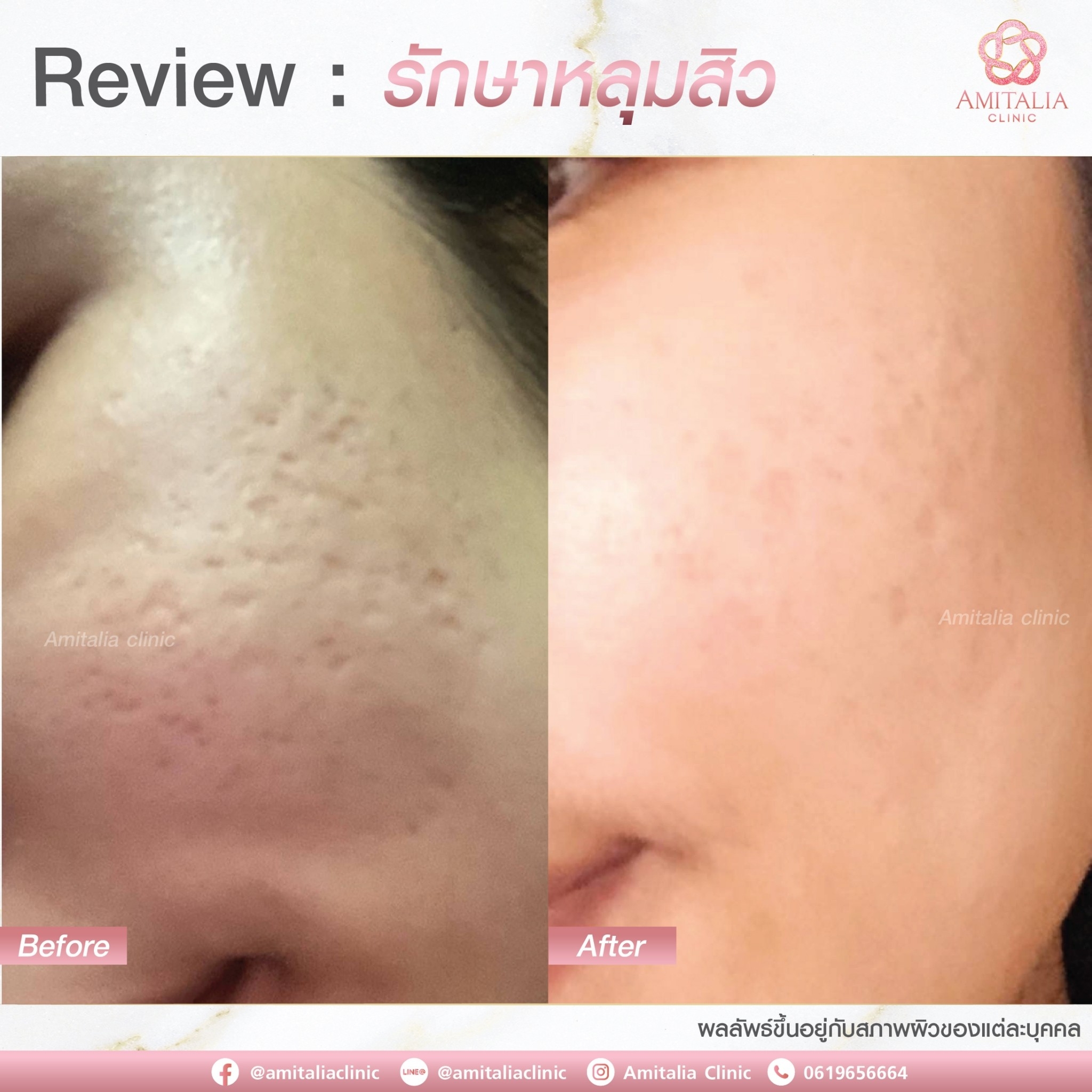 Review รักษาหลุมสิว11-AmitaliaClinic