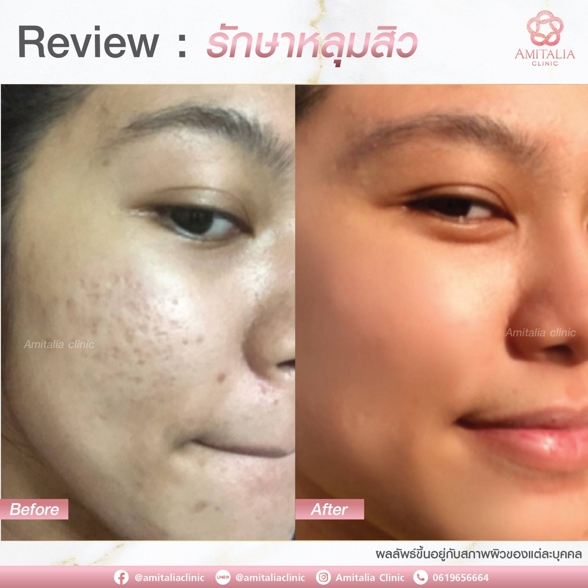 Review รักษาหลุมสิว12-AmitaliaClinic