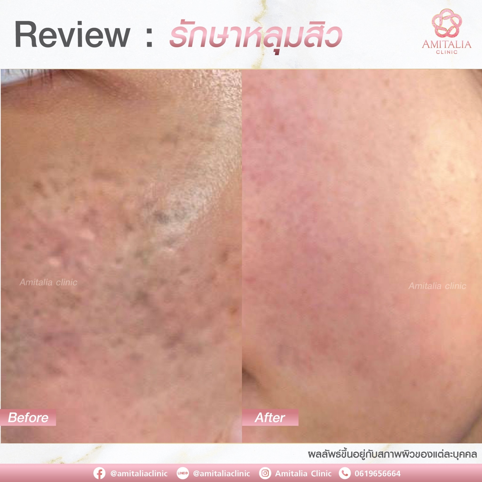 Review รักษาหลุมสิว #8