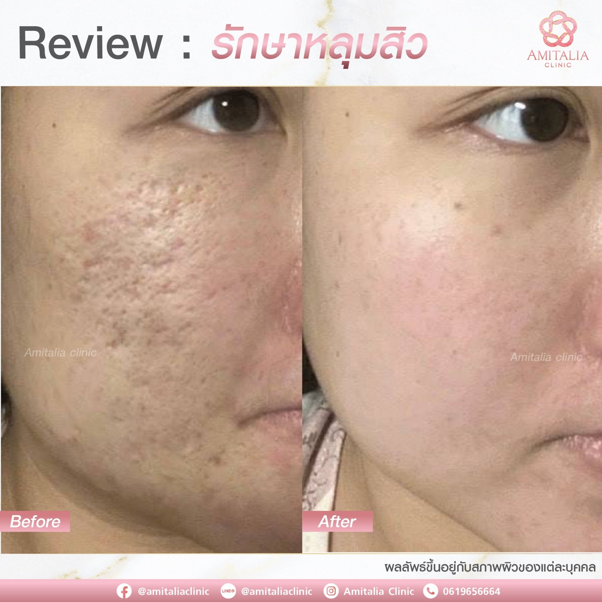 Review รักษาหลุมสิว9-AmitaliaClinic