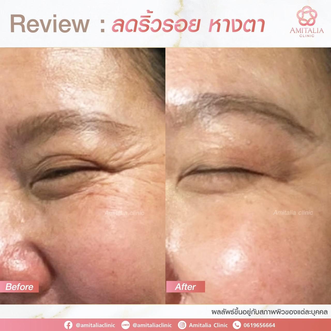 Review ลดริ้วรอย หางตา14-AmitaliaClinic