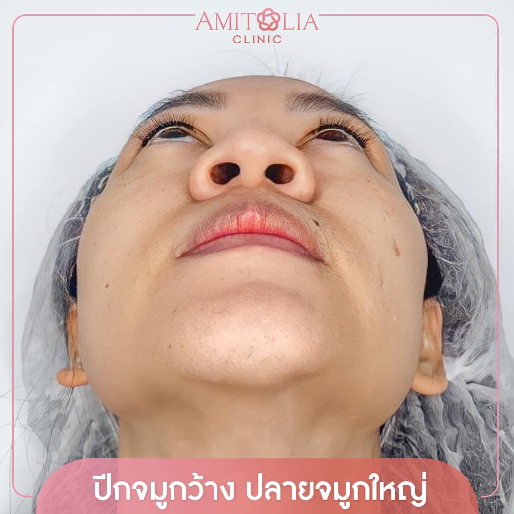 Review ตัดปีกจมูก 39 AmitaliaClinic