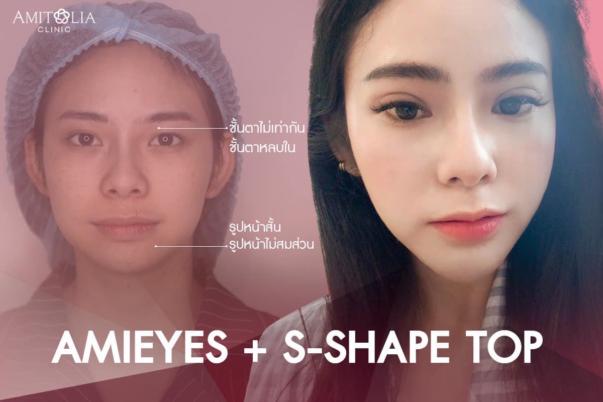 Review ตาสองชั้น + เสริมคาง #32