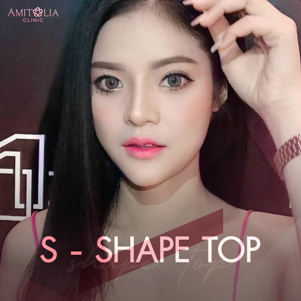 Review เสริมคาง #19