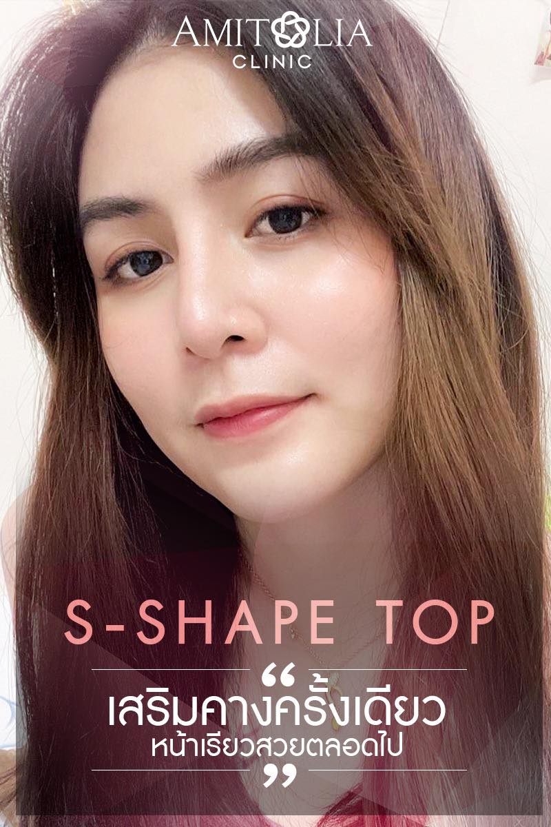 Review เสริมคาง #21