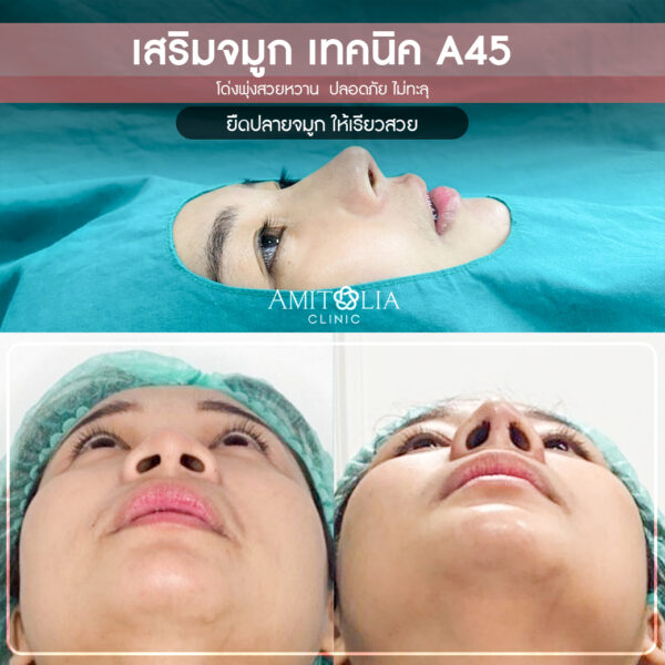 Review เสริมจมูก 30 AmitaliaClinic