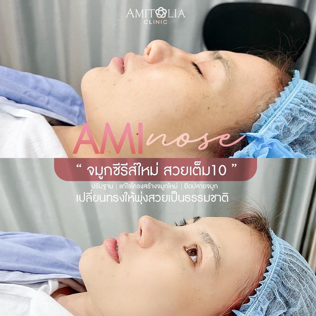 Review เสริมจมูก #34