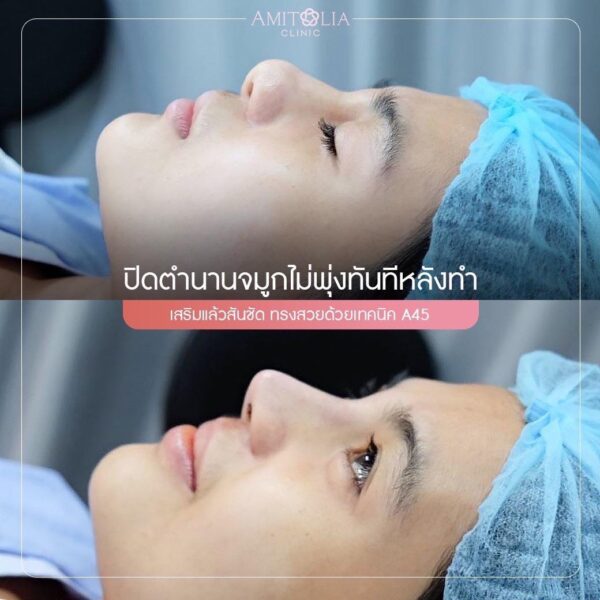 Review เสริมจมูก 35 AmitaliaClinic