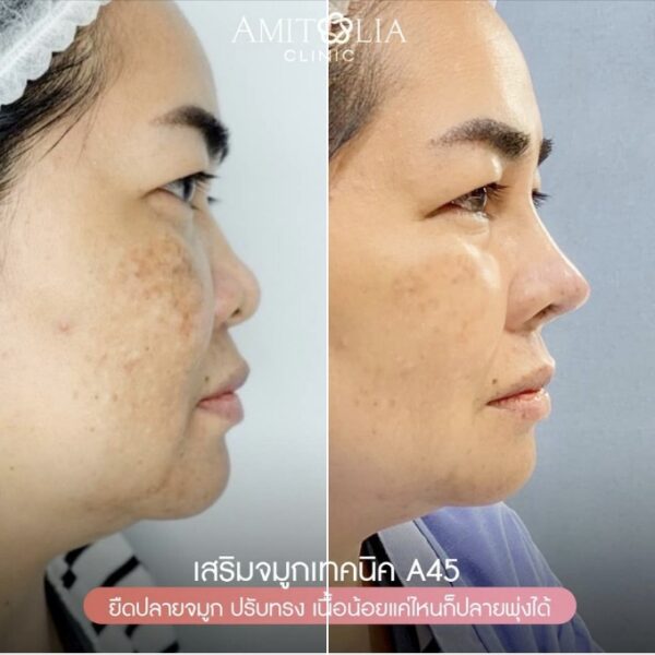 Review เสริมจมูก 41 AmitaliaClinic