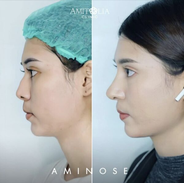 Review เสริมจมูก 42 AmitaliaClinic