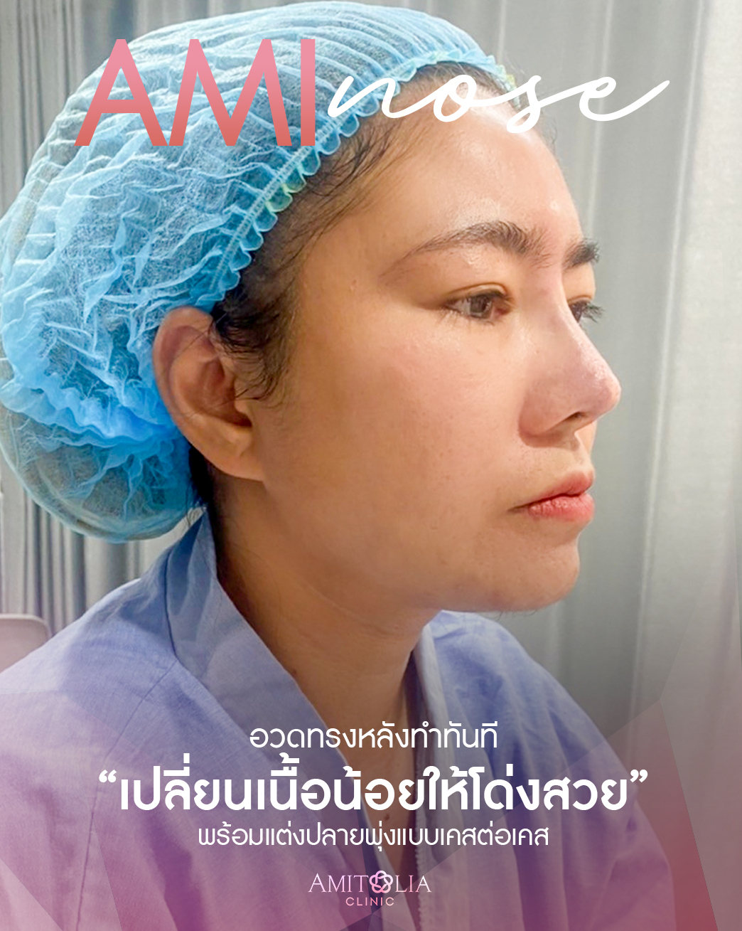 Review เสริมจมูก-AmitaliaClinic