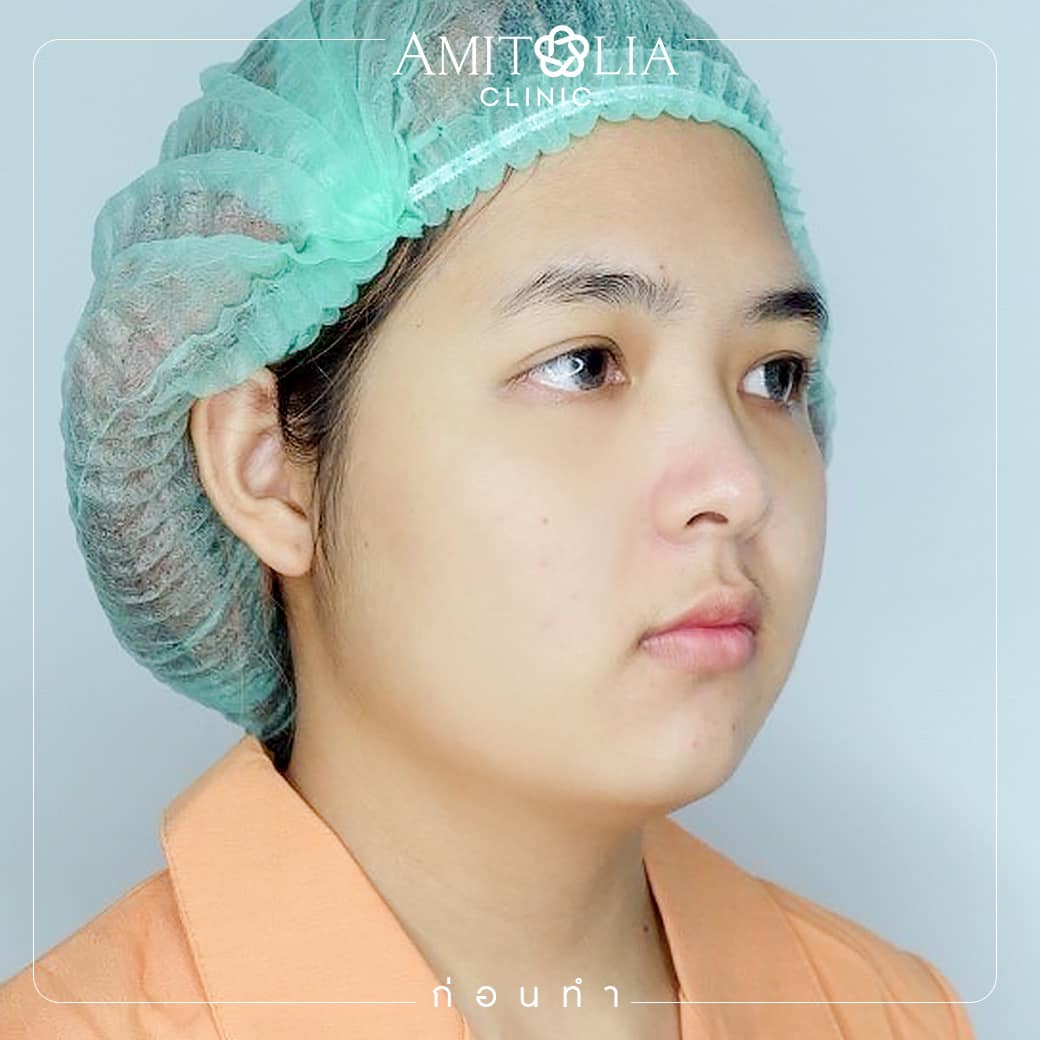 Review เสริมจมูก-AmitaliaClinic