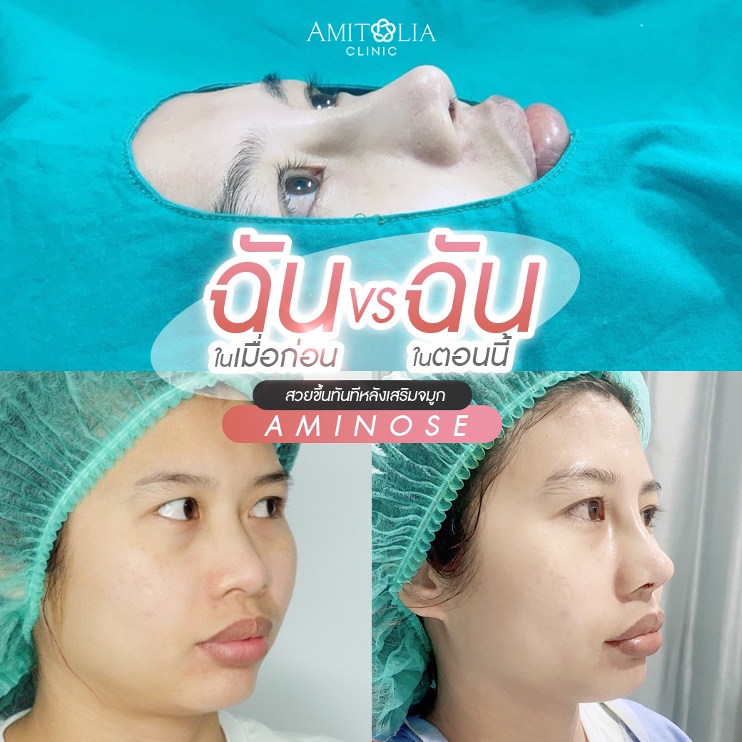 Review เสริมจมูก-AmitaliaClinic