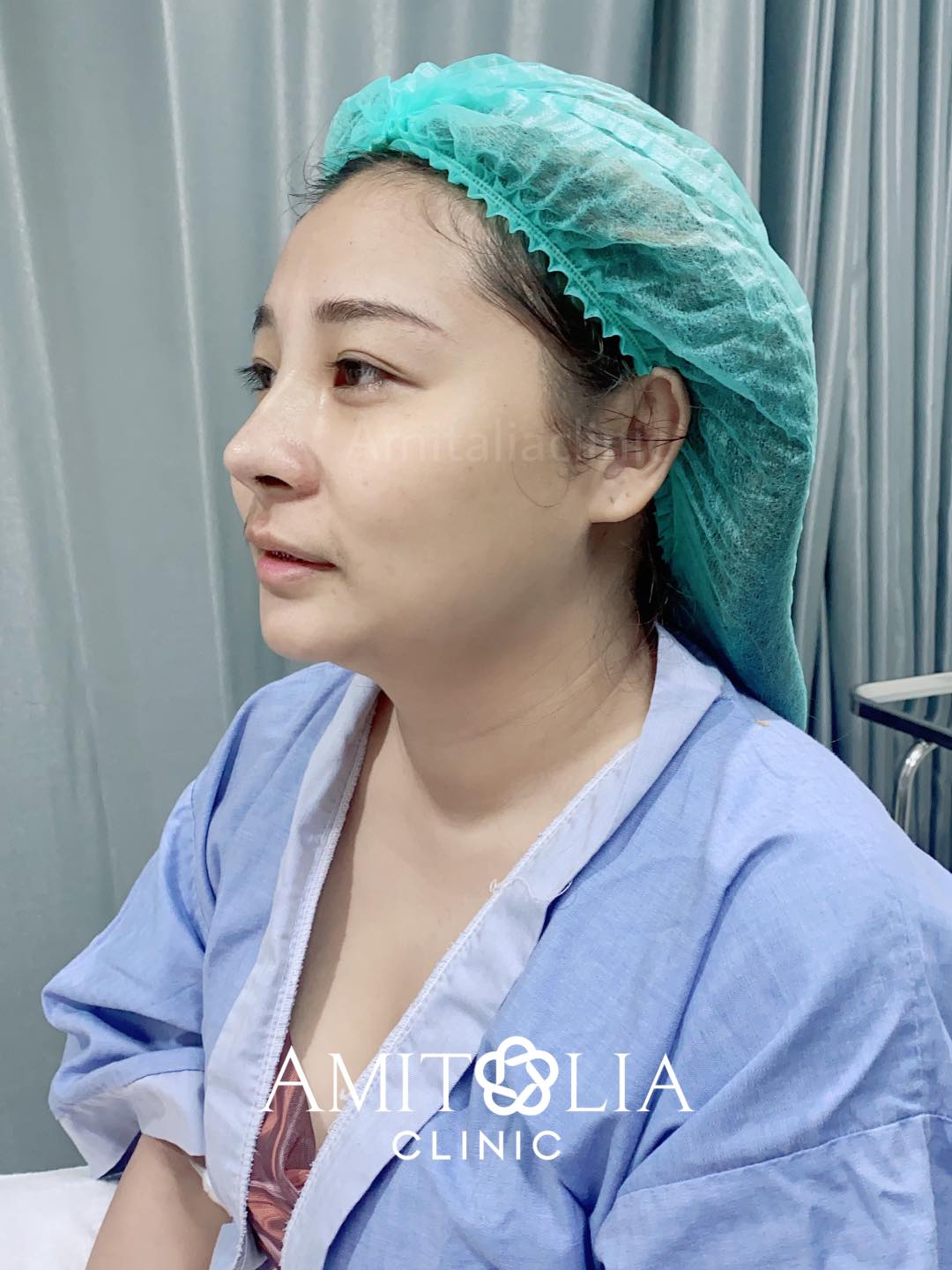 Review เสริมจมูก-AmitaliaClinic