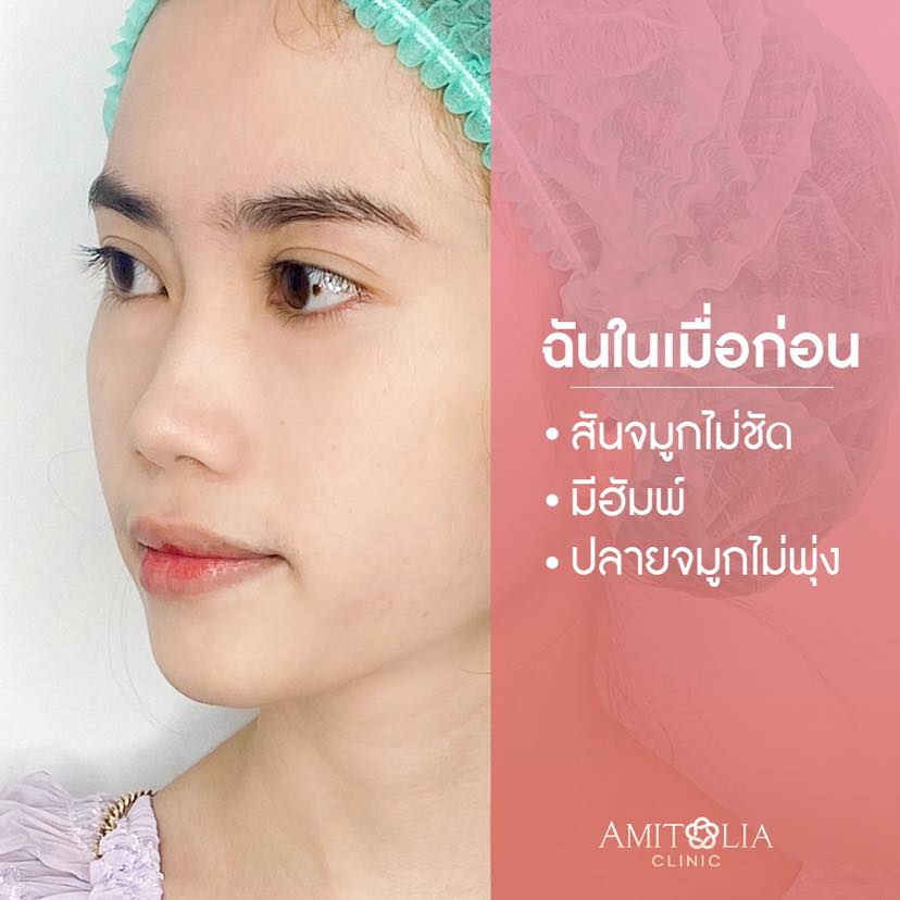 Review เสริมจมูก-AmitaliaClinic