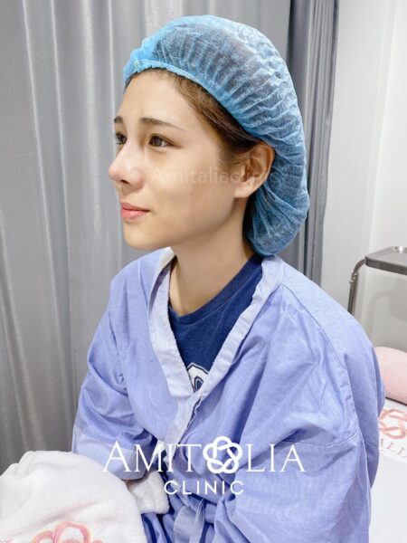 Review แก้จมูก 33 AmitaliaClinic