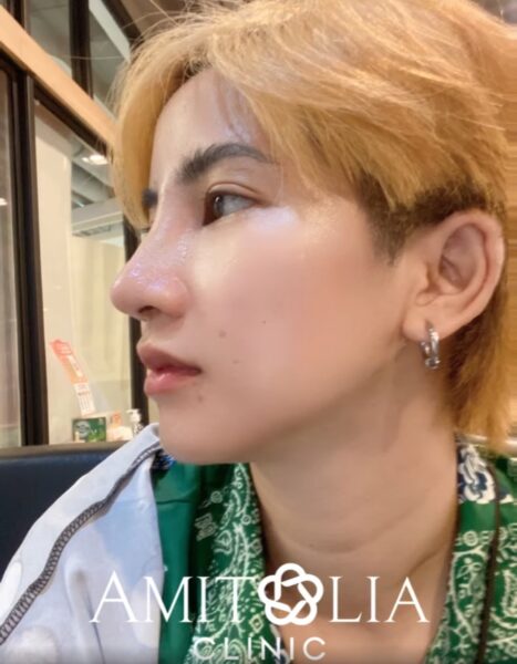 Review แก้จมูก 37 AmitaliaClinic