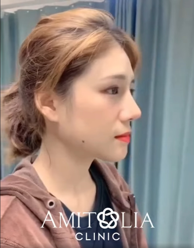 Review แก้จมูก #38