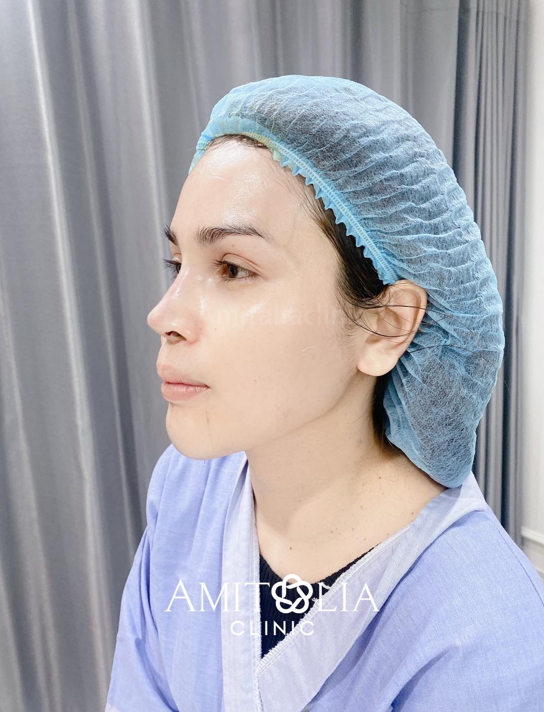 Review แก้จมูก + เสริมคาง-AmitaliaClinic