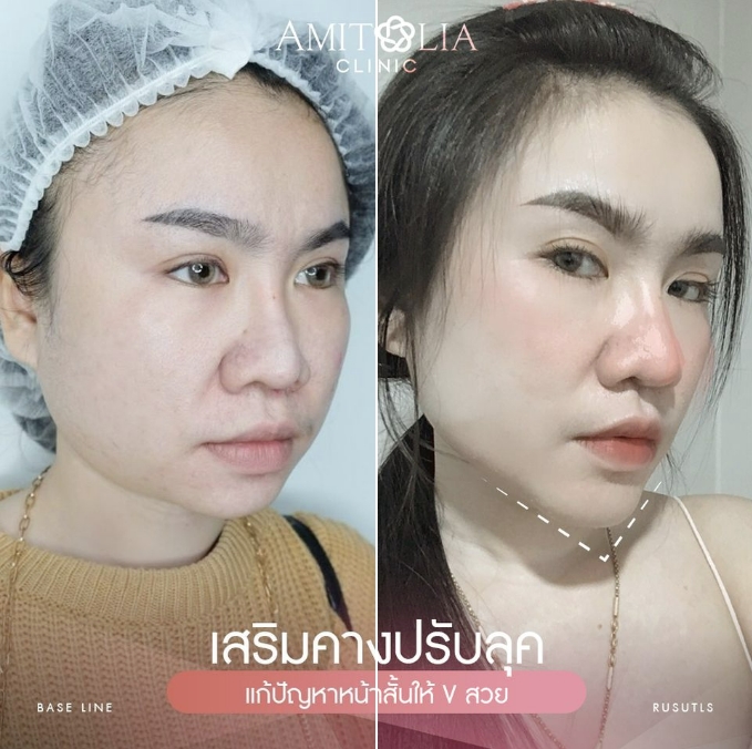 Review เสริมคาง #23