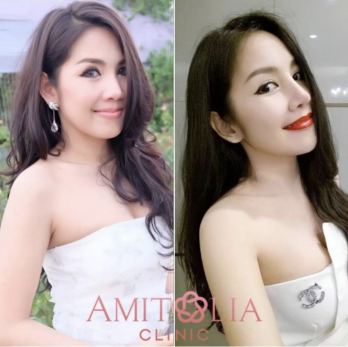 Review เสริมจมูก 50 AmitaliaClinic