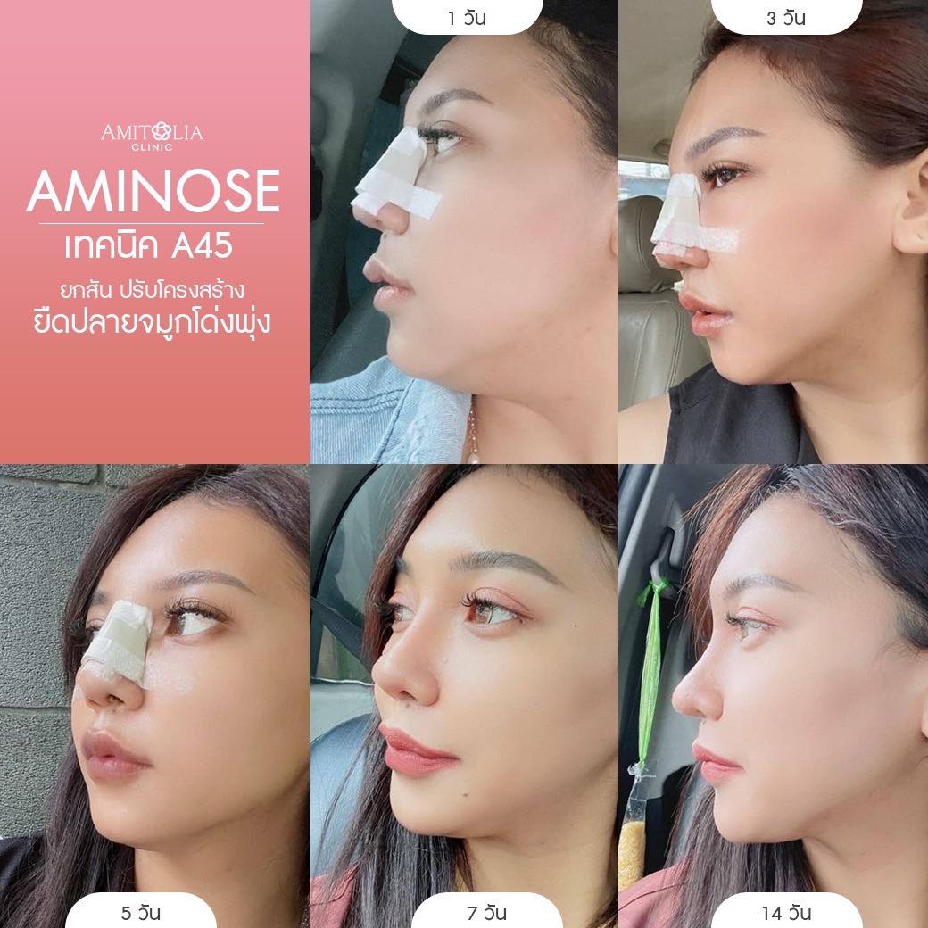 Review เสริมจมูก 51 AmitaliaClinic