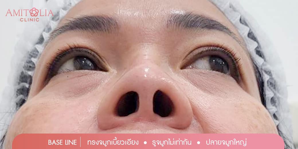 Review แก้จมูก #43