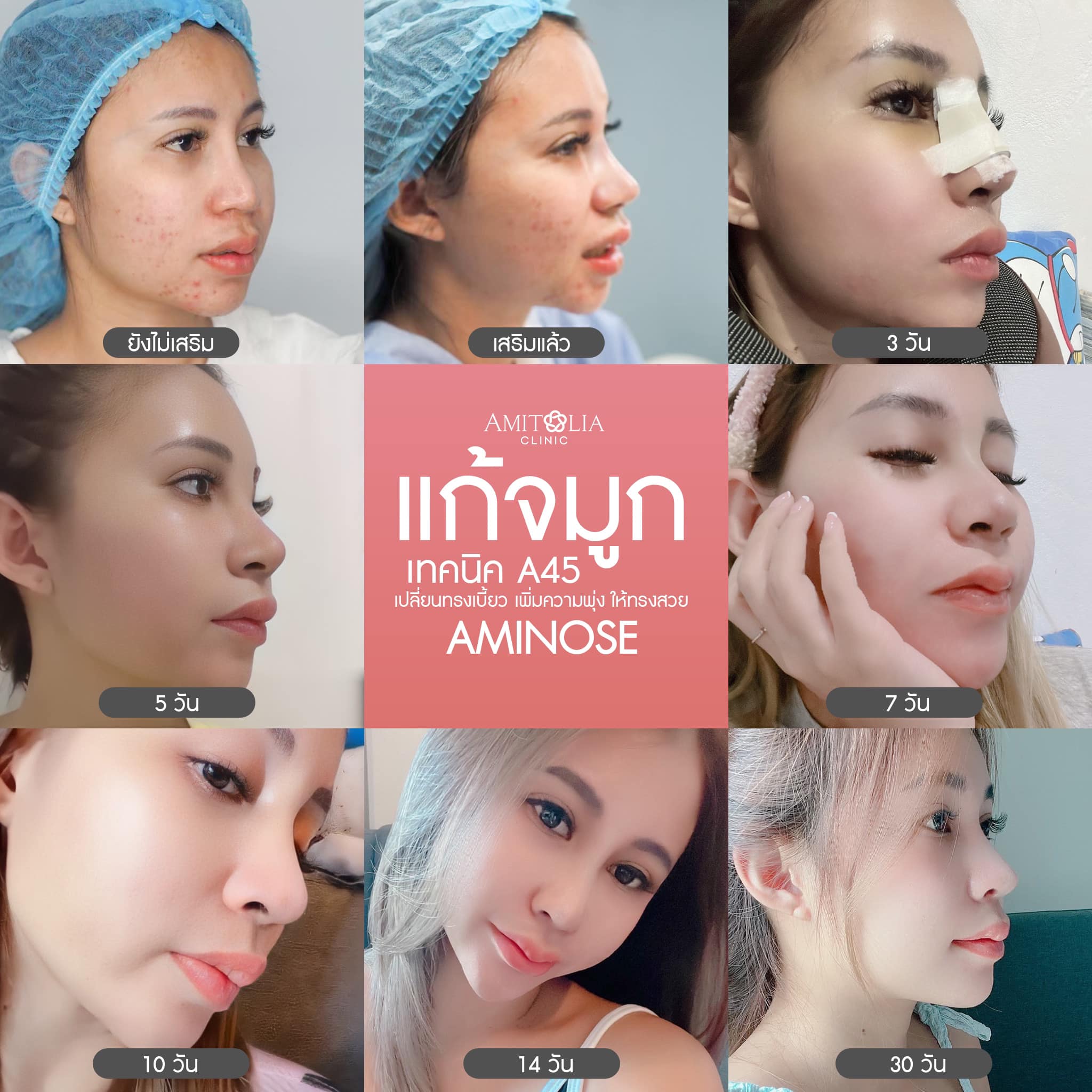 Review แก้จมูก 44 AmitaliaClinic