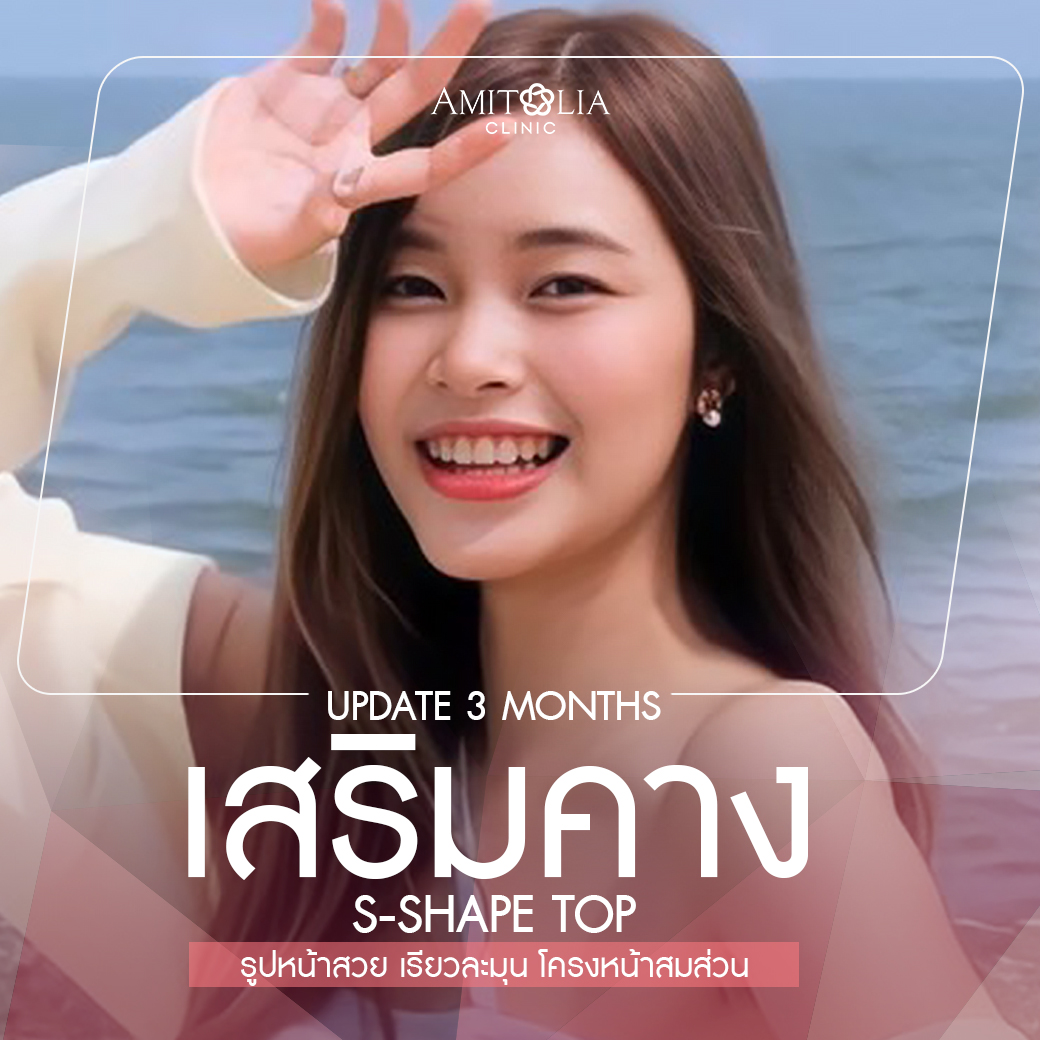 Review เสริมคาง #24