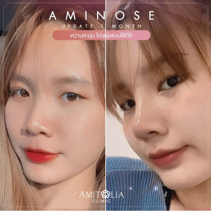 Review เสริมจมูก 55 AmitaliaClinic