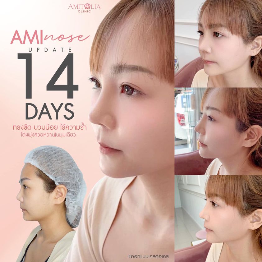 Review เสริมจมูก #59