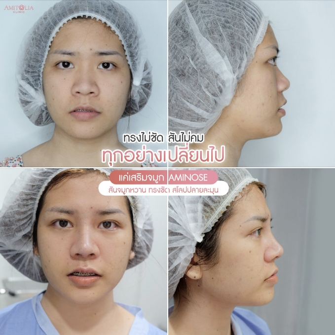 Review เสริมจมูก 60 AmitaliaClinic