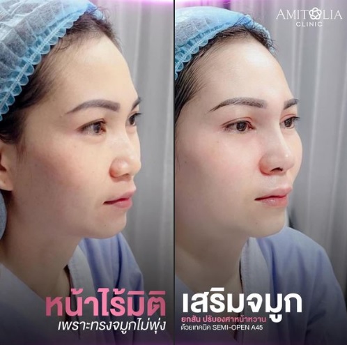 Review เสริมจมูก #61