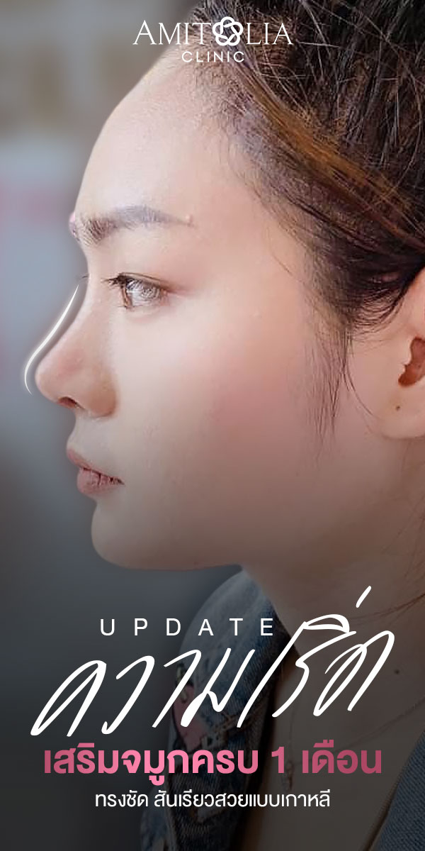 Review เสริมจมูก #63