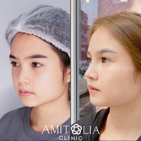 Review เสริมจมูก #76