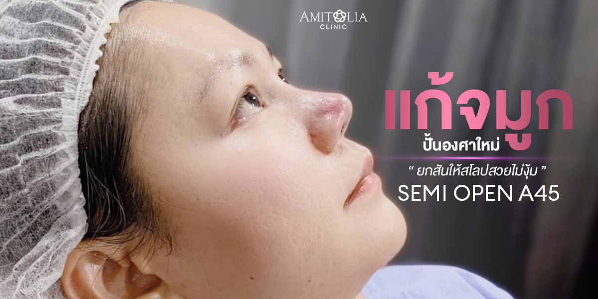 Review แก้จมูก #67