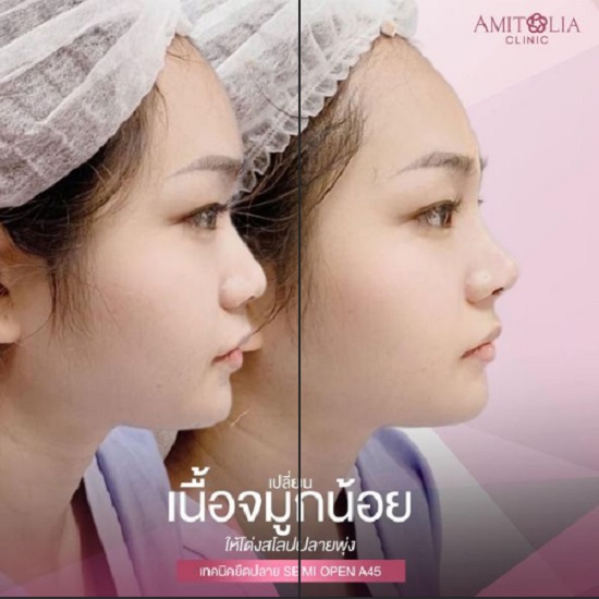 Review เสริมจมูก #133