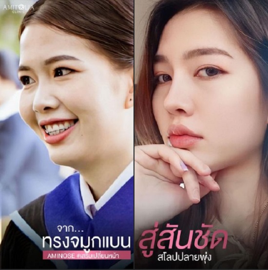 Review เสริมจมูก #134