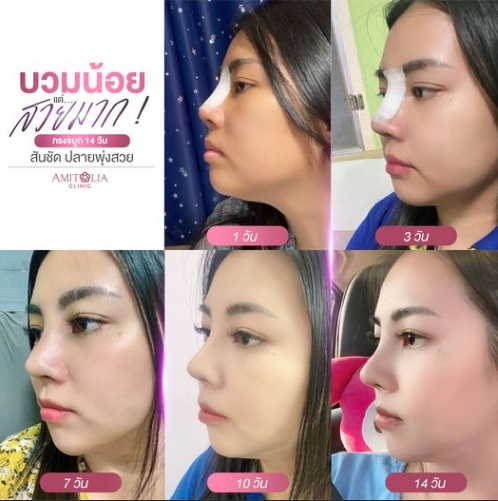 Review เสริมจมูก #80