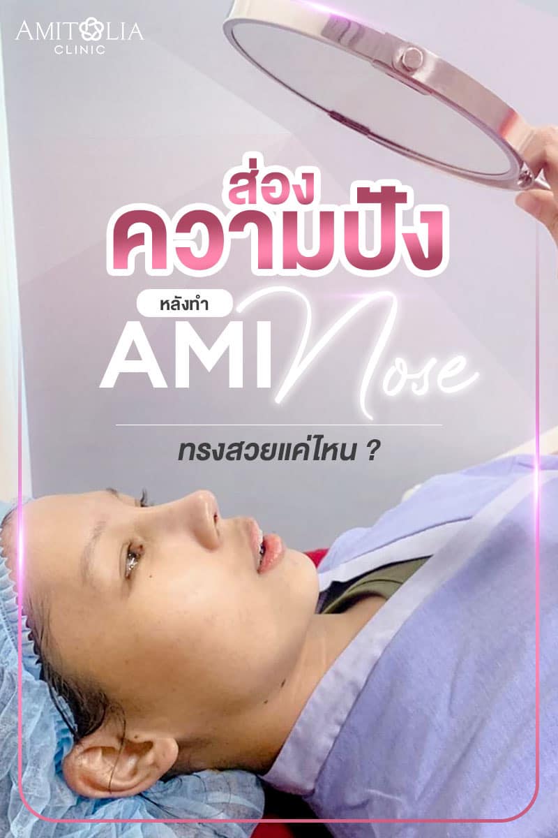 Review เสริมจมูก #94